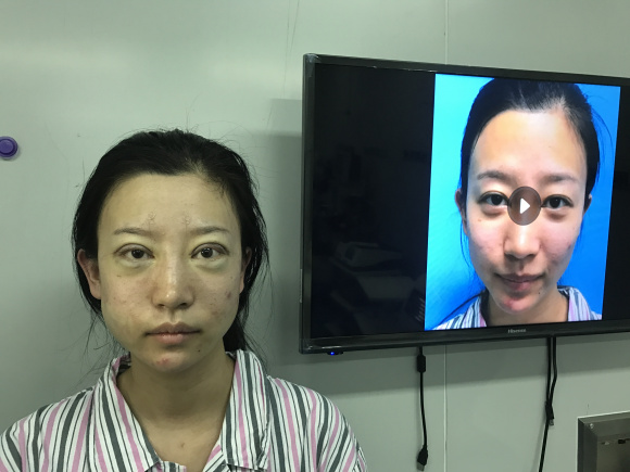 营口/鞍山元辰双眼皮风格怎么样?【案例|点评】