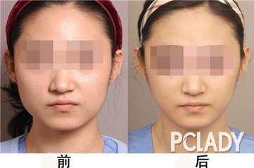 圣嘉新张笑天做下颌角做的如何?【案例|点评】