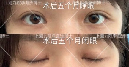 上海九院李海洲医生全切双眼皮+内眼角手术案