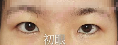 上海九院王文进医生全切双眼皮+开眼角手术案