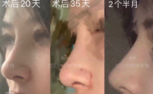 武汉协和钟爱梅医生半肋鼻部手术+缩鼻翼+鼻基底