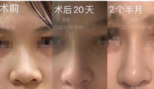 武汉协和钟爱梅医生半肋鼻部手术+缩鼻翼+鼻基底
