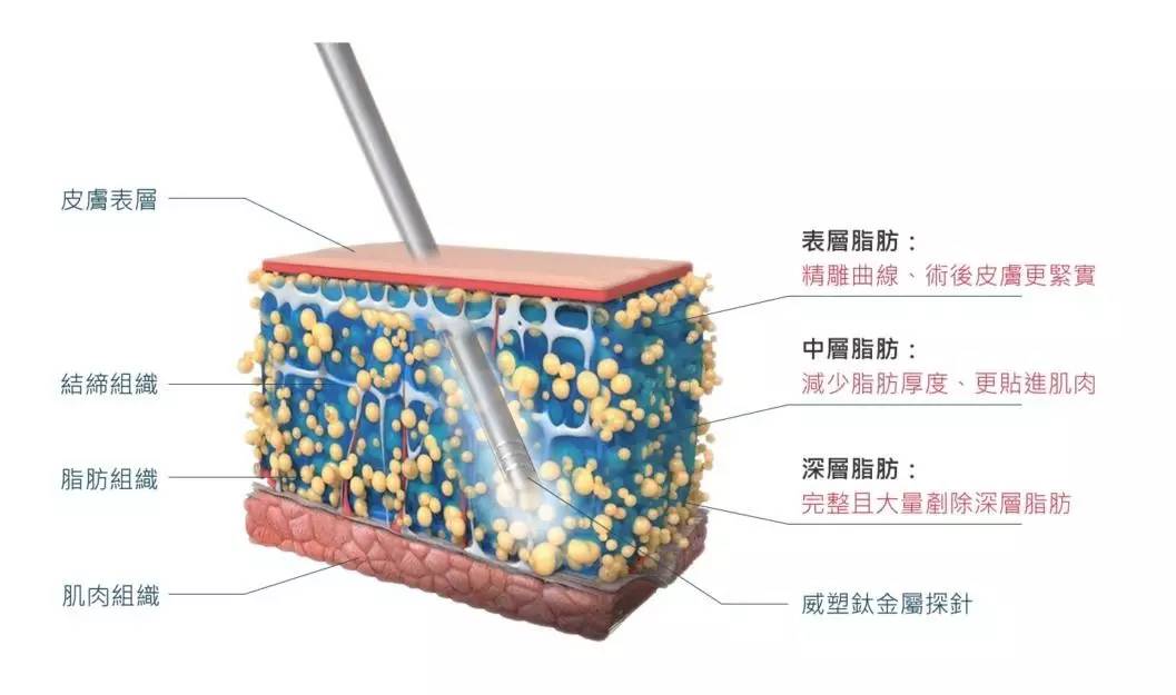杭州华颜威塑吸大小腿技术怎么样?【案例|盘点