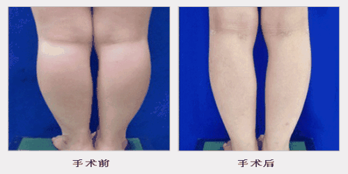 杭州华颜威塑吸大小腿技术怎么样?【案例|盘点