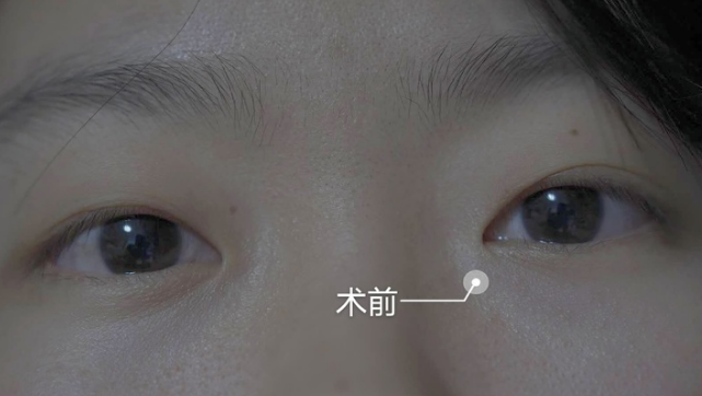 烟台美神韩冰主任做双眼皮技术怎么样?【案例