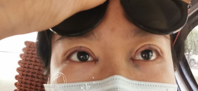 烟台美神韩冰主任做双眼皮技术怎么样?【案例