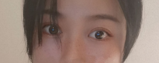 烟台美神韩冰主任做双眼皮技术怎么样?【案例