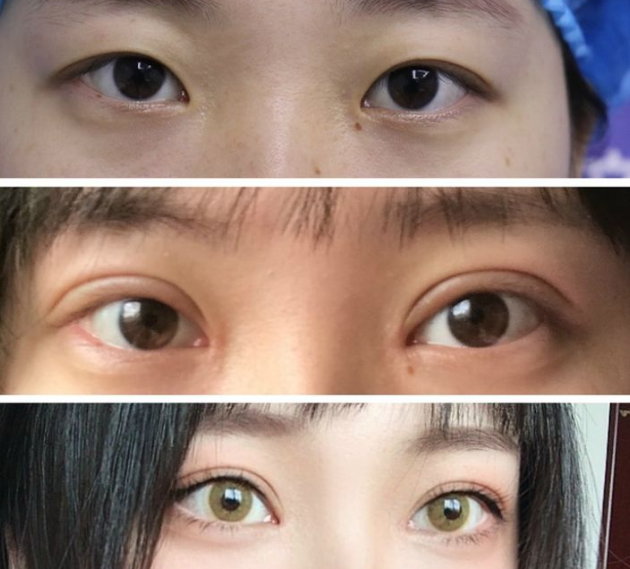 郑州善美徐英杰双眼皮技术怎么样?【案例|盘点