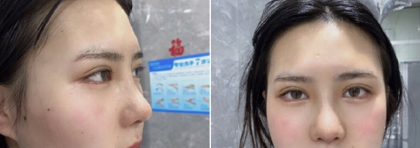 长沙欣颜医疗美容靳海涛医生眼部手术鼻部手术案例