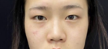 长沙欣颜医疗美容靳海涛医生眼部手术鼻部手术案例