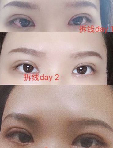 长沙韩美刘萌医生双眼皮眼部手术手术案例