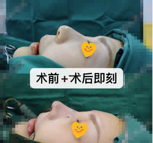 匠歆天巧同济邓裴医生做的半肋鼻部手术手术案例