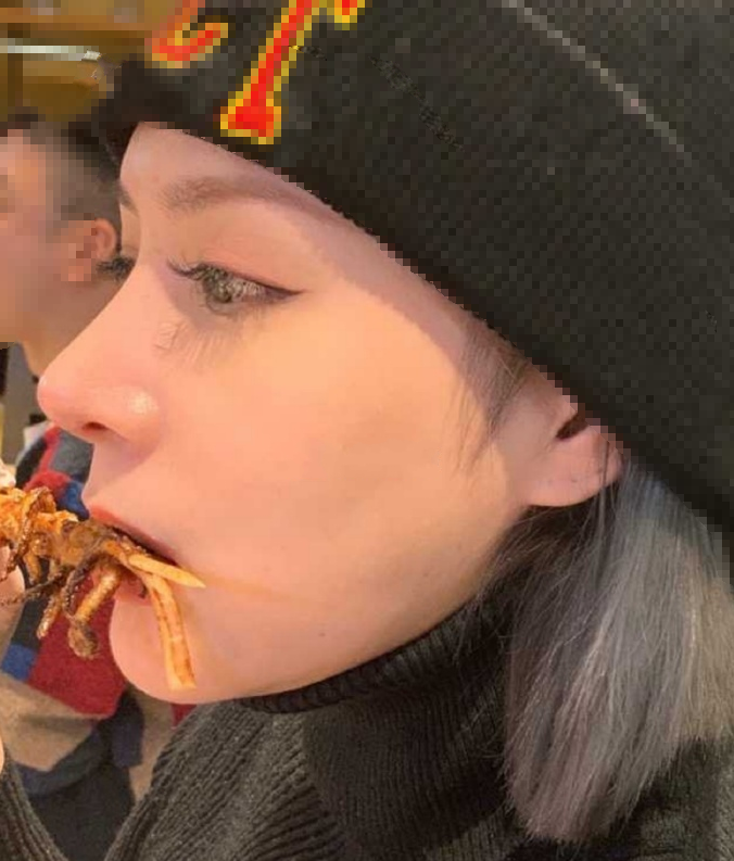 匠歆天巧同济邓裴医生做的半肋鼻部手术手术案例