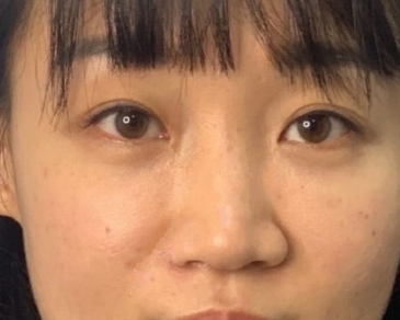 武汉华科大同济医学院张继强医生鼻部手术手术案