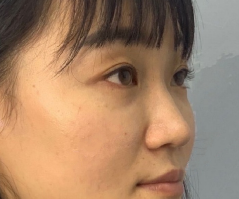 武汉华科大同济医学院张继强医生鼻部手术手术案