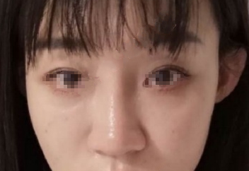 武汉华科大同济医学院张继强医生鼻部手术手术案