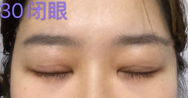 江苏省中医院陈刚医生双眼皮提肌眼袋填充泪沟