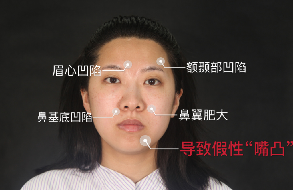 北京俊泰丽格薛志强人工骨膨体鼻部手术+脂肪填充