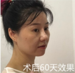 武汉华科大同济医学院张继强医生半肋鼻部手术手