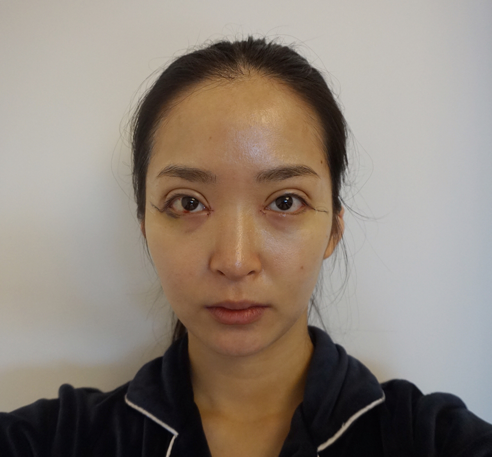 曹仁昌做眼部修复风格怎么样?【案例|盘点】
