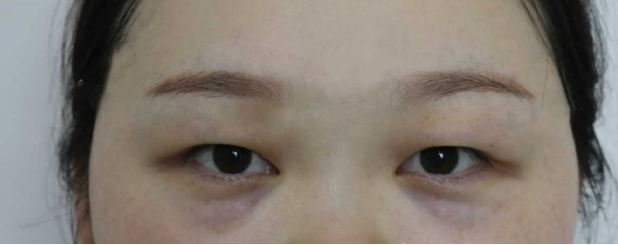 长沙伊美整形医院刘芳roof脂肪,内切眼袋案例
