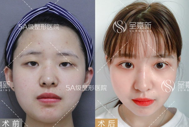 陈圣英双眼皮风格怎么样?【案例|盘点】