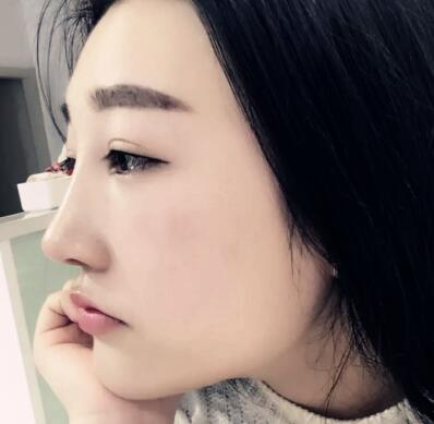 修志夫整形做鼻子风格怎么样?【案例|盘点】