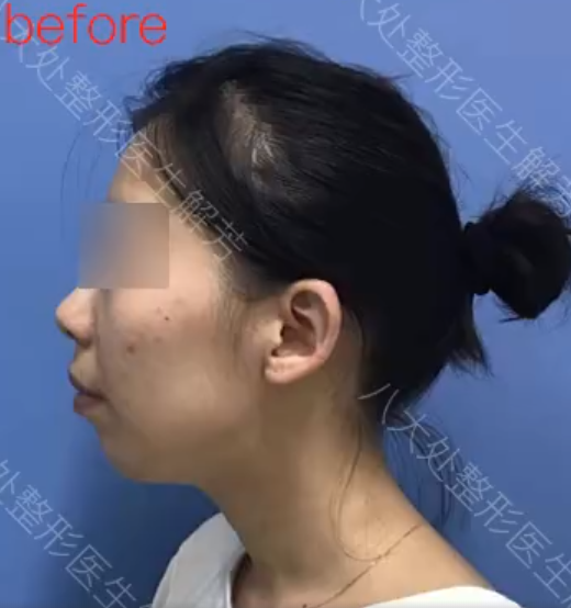 北京八大处解芳医生下巴截骨前移+脂肪填充手