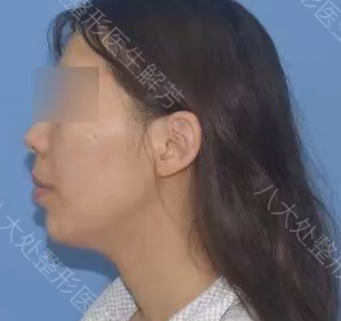 北京八大处解芳医生下巴截骨前移+脂肪填充手