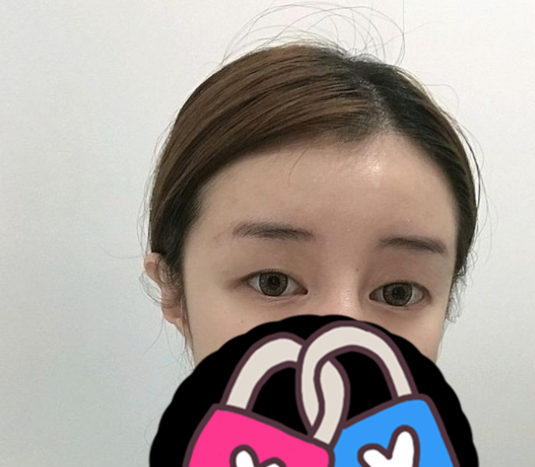 张霞做双眼皮手术风格怎么样?【案例|盘点】