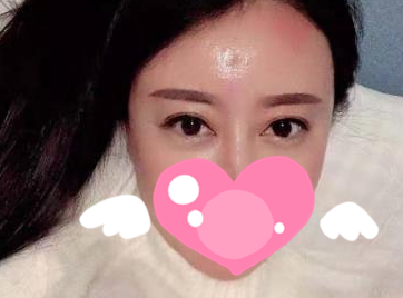 哈尔滨斯美诺王晓波做双眼皮风格怎么样?【案