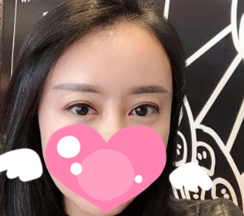 哈尔滨斯美诺王晓波做双眼皮风格怎么样?【案