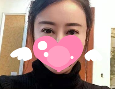 哈尔滨斯美诺王晓波做双眼皮风格怎么样?【案