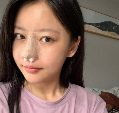 李开征院长做芭比软糖肋骨鼻术风格怎么样?【
