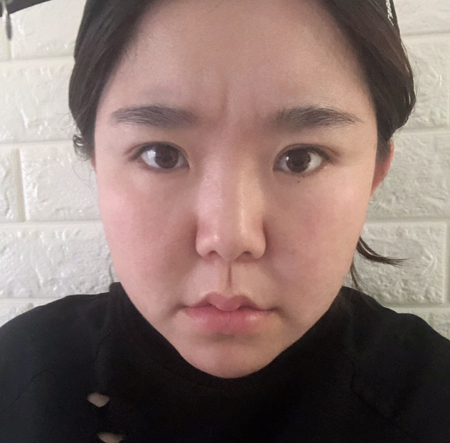 斯美诺张宁教授做修复手术风格怎么样?【案例