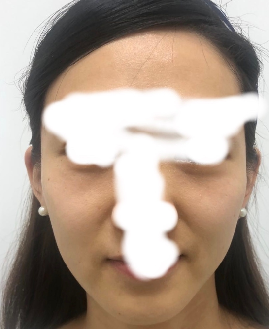 上海维九的方建蔺医生抗衰线提升苹果肌复位案