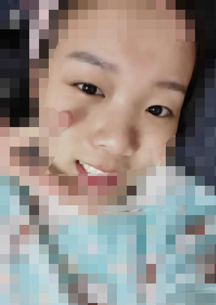长沙欣颜医疗美容靳海涛医生鼻部手术手术案例