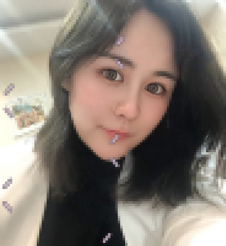 杭州艺星张龙医生半肋鼻部手术手术案例