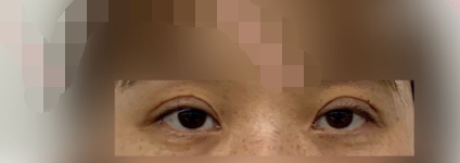 上海九院王梓全切双眼皮手术案例