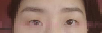 武汉卓美整形王海平教授双眼皮+开眼角手术案