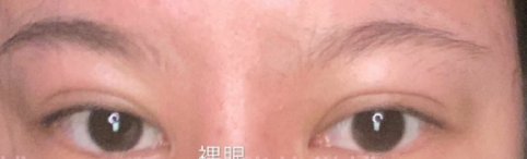 广州曙光医院陈丽珍医生眼部手术手术案例