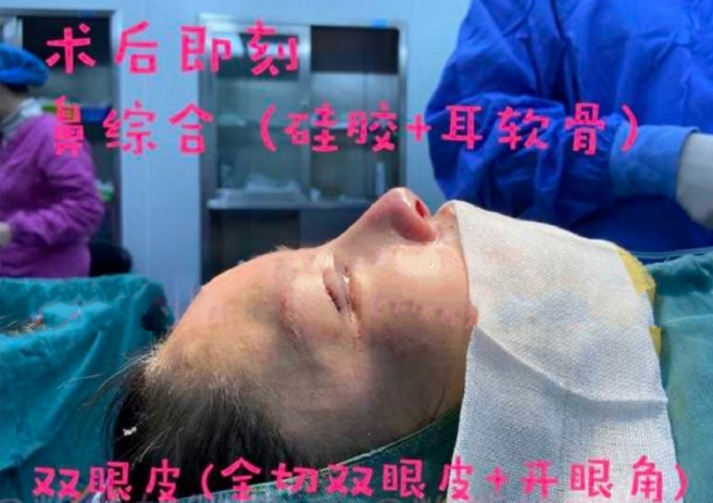 成都恒博天姿肖凌鼻部手术+全切双眼皮+内眼角案例