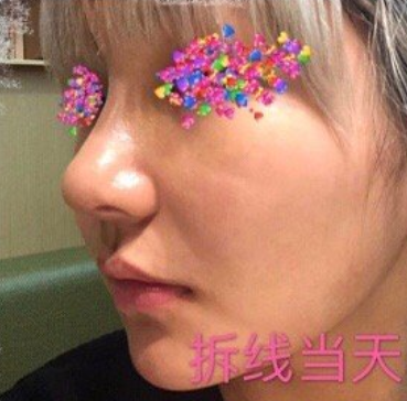 成都维度医疗周维医生膨体肋软骨鼻部手术+鼻基底