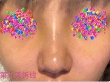 成都维度医疗周维医生膨体肋软骨鼻部手术+鼻基底