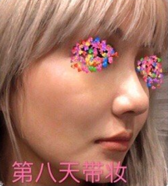 成都维度医疗周维医生膨体肋软骨鼻部手术+鼻基底