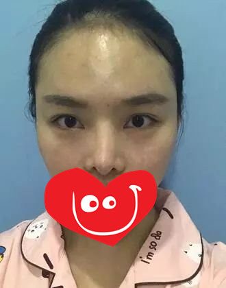 杭州徐立刚鼻修复肋骨鼻风格怎么样?【案例|点