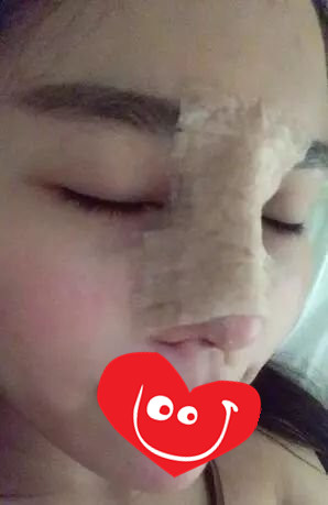 杭州徐立刚鼻修复肋骨鼻风格怎么样?【案例|点