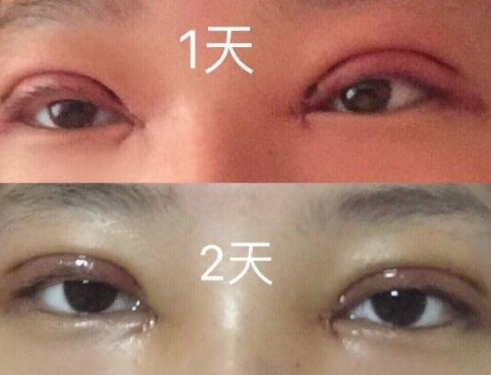 赵绛波医生双眼皮风格怎么样?【案例|点评】