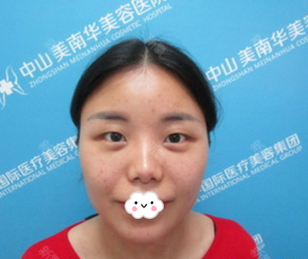中山美南华美容医院赖院双眼皮风格怎么样?【