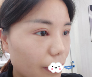 中山美南华美容医院赖院双眼皮风格怎么样?【